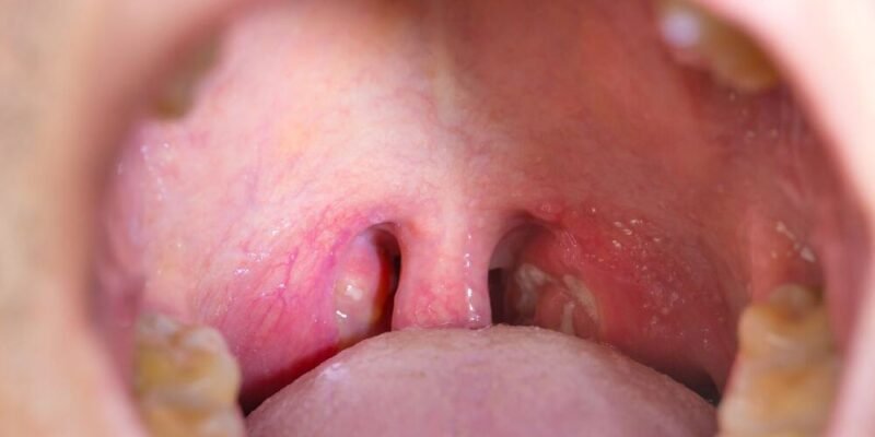 Can Tonsils Grow Back After Being Removed - Tymoff