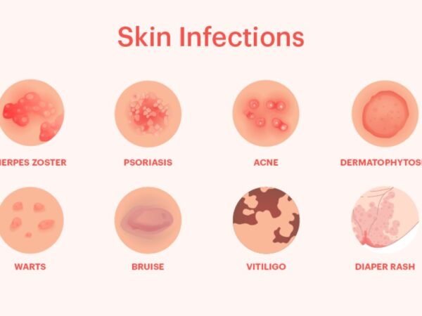 Common Types of Skin Infections