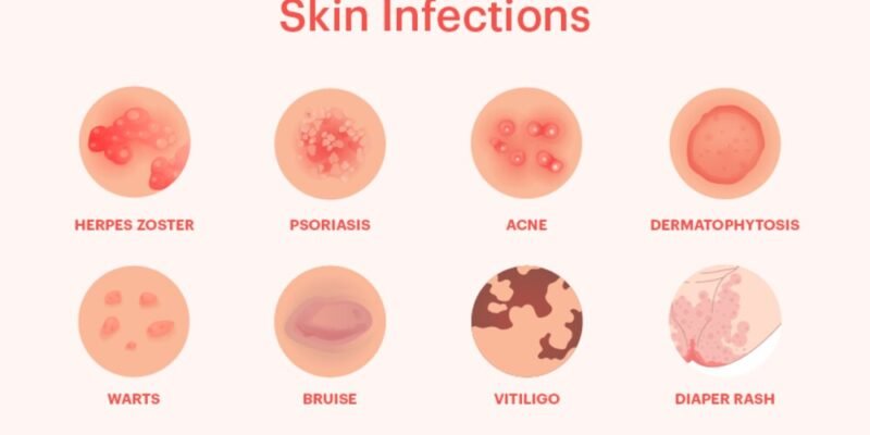 Common Types of Skin Infections