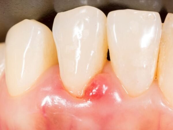 Identifying and Treating Spots and Lines on Your Teeth